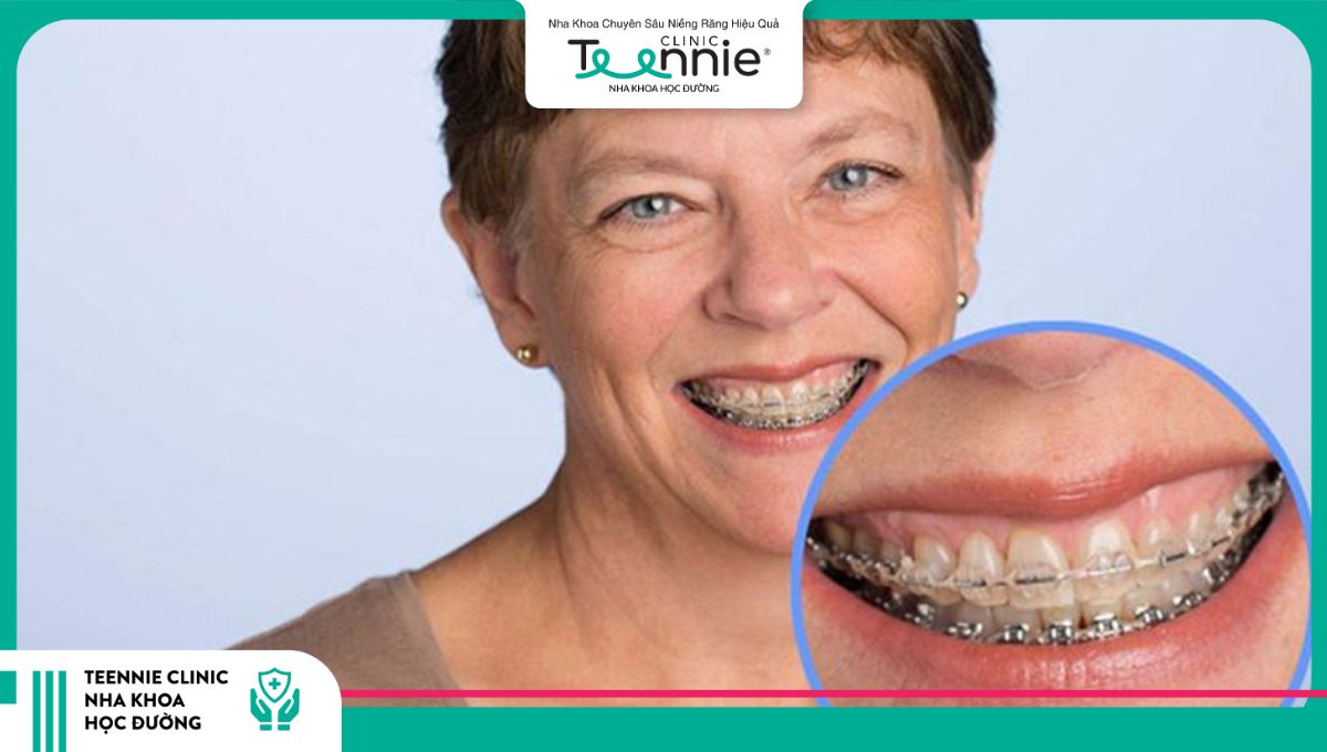 40 tuổi niềng răng trung bình lên đến khoảng 3 năm 