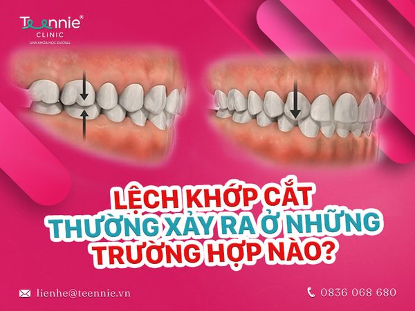 Niềng răng lệch khớp cắn xảy ra ở trườn hợp nào?