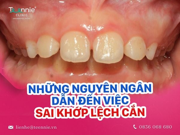 Những nguyên nhân dẫn đến niềng răng lệch khớp cắn