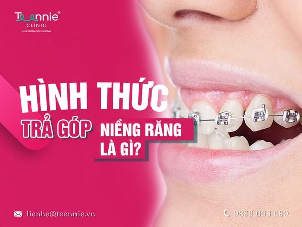 Hình thức trả góp niềng răng phù hợp cho những khách hàng có điều kiện tài chính còn eo hẹp