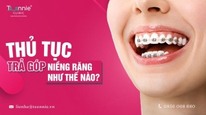 Thủ tục niềng răng trả góp quy trình như thế nào?