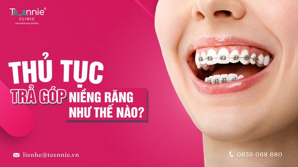 Thủ tục niềng răng trả góp quy trình như thế nào?