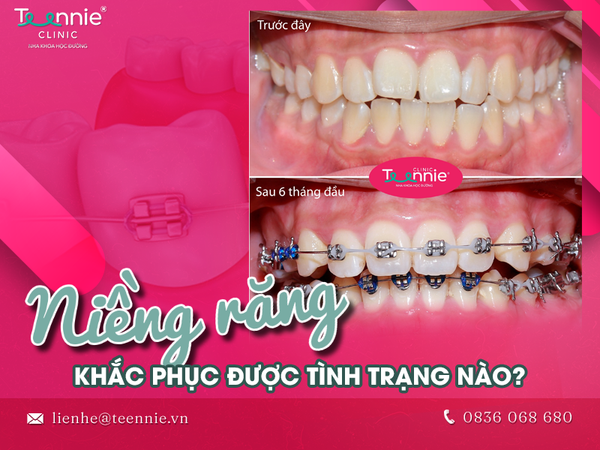 Những dấu hiệu khi mới niềng răng là gì?