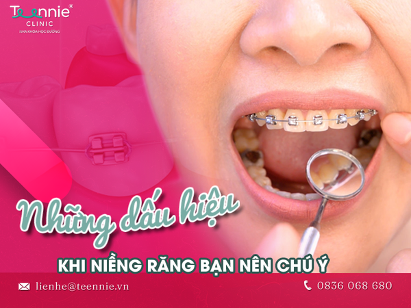Bạn nên chú ý những dấu hiệu khi mới niềng răng