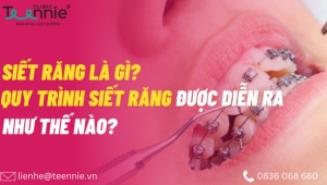 Siết răng khi niềng là gì? Quy trình diễn ra như thế nào?