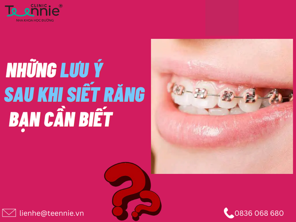 Những lưu ý sau khi siết răng
