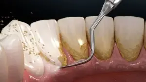Cạo vôi răng thường xuyên có ảnh hưởng gì không?