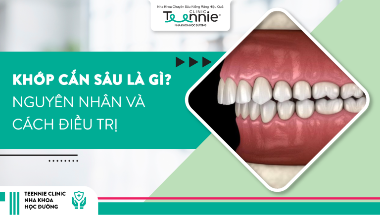 Tìm hiểu khớp cắn sâu là gì? Nguyên nhân và cách điều trị