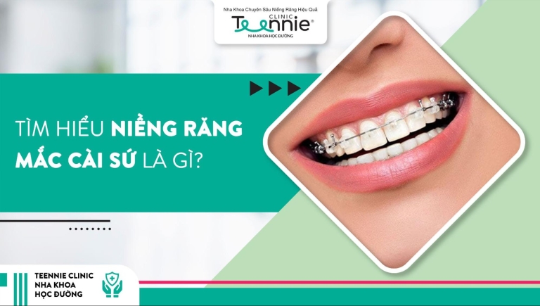 Niềng răng mắc cài sứ và những thông tin cần biết