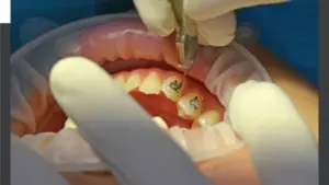 Niềng răng ở giai đoạn nào đau nhất?