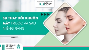 Sự thay đổi của khuôn mặt trước và sau khi niềng răng