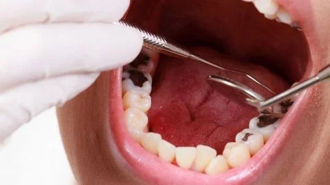 5 cách chữa trị sâu răng hàm tại nhà hiệu quả