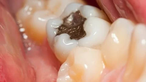 Áp dụng cách ngừa sâu răng cho mọi đối tượng