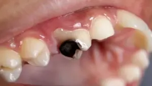 Cách ngăn ngừa tình trạng sâu răng hiệu quả