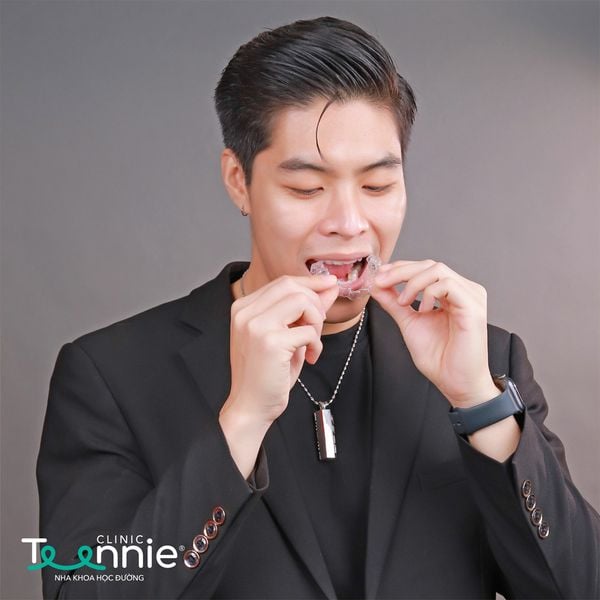 Niềng răng cửa thưa do nguyên nguyên khách quan