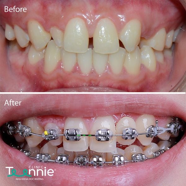 Chí phí niềng răng cửa thưa chi tiết