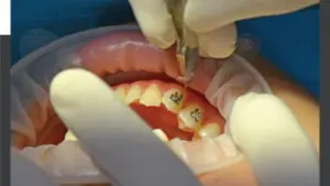 Niềng răng có làm giảm tuổi thọ hay không?
