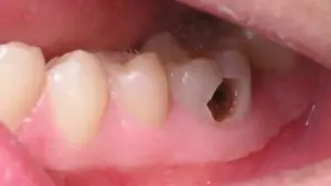 Sâu răng vào tủy gặp bác sĩ để tránh hậu quả