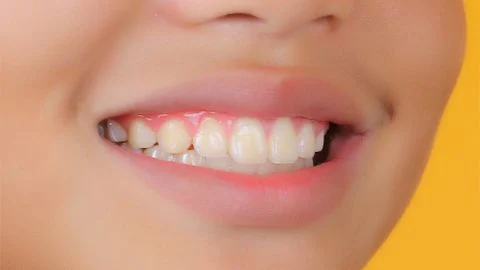 Nghiến răng vào ban đêm: Nguyên nhân do đâu?