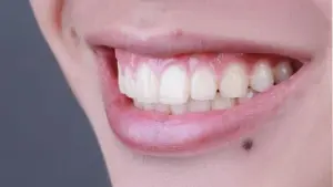 8 biểu hiện nhiễm trùng sau nhổ răng khôn