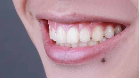 8 biểu hiện nhiễm trùng sau nhổ răng khôn