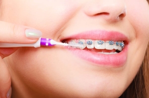 Dụng cụ vệ sinh răng niềng bàn chải kẽ