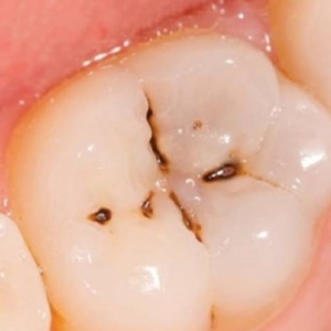 6 nguyên nhân khiến răng xuất hiện vết đen
