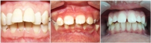 Trước và sau khi niềng răng hô