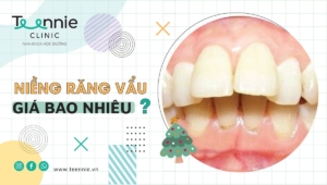 Bạn có biết niềng răng vẩu giá bao nhiêu?