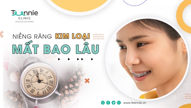 Bật mí niềng răng mắc cài kim loại mất bao lâu?