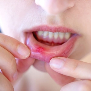 Cách điều trị tình trạng loét miệng hiệu quả