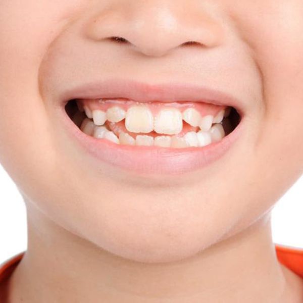Cách điều trị tình trạng răng nhiễm flo ở trẻ