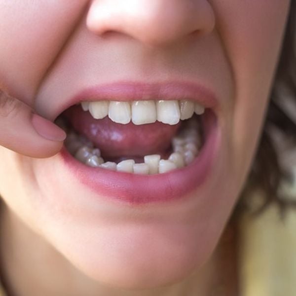 Cách khắc phục tình trạng răng không đều