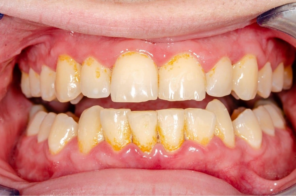 Cạo vôi răng định kỳ có tốt cho răng miệng?
