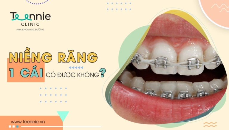 Chỉ niềng răng 1 cái có được không? Giá bao nhiêu?