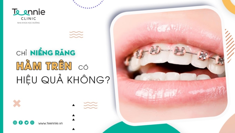 Chỉ niềng răng hàm trên có hiệu quả không?