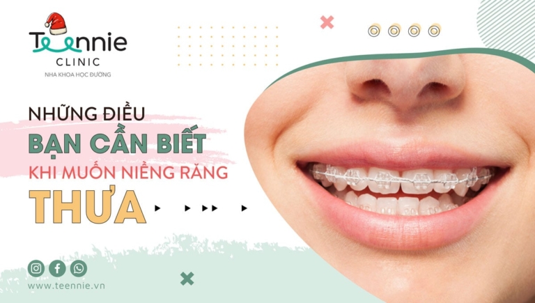 Chia sẻ những kinh nghiệm niềng răng thưa mà bạn cần biết