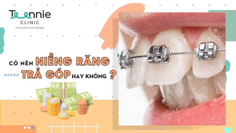 Có nên niềng răng trả góp hay không?