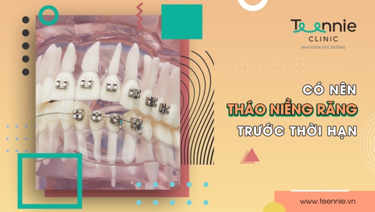 Có nên tháo niềng răng trước thời hạn không?