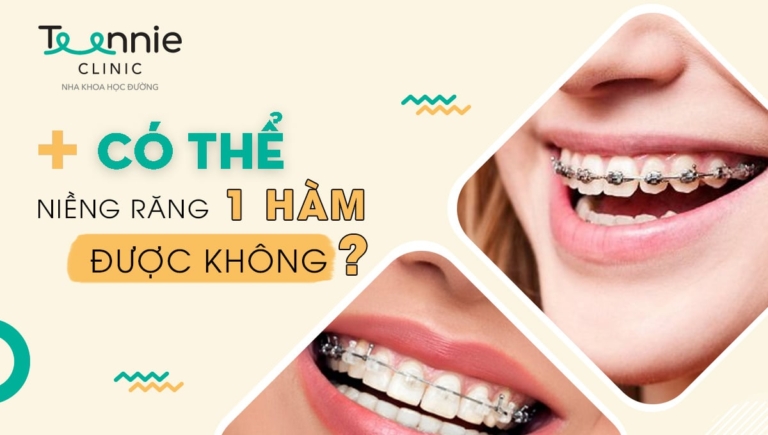 Có thể niềng răng một hàm được không? Hiệu quả như thế nào?