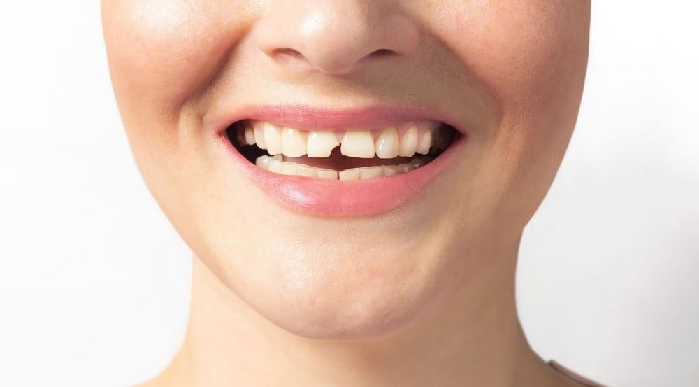 Đau nhức do răng bị sứt mẻ, làm sao để khắc phục?