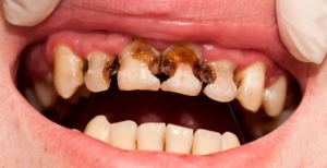 Điểm danh các bệnh răng miệng thường gặp ở trẻ em