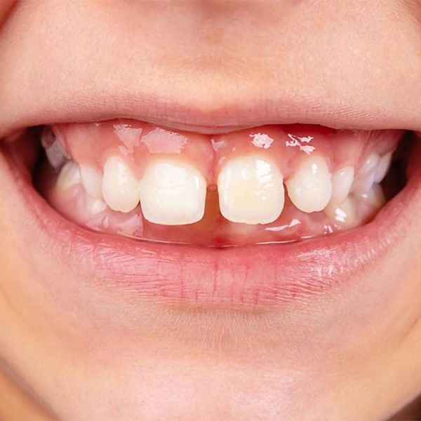 Điều trị răng thưa như thế nào mới hiệu quả?