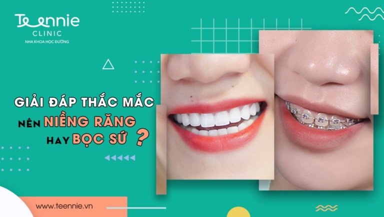 Giải đáp thắc mắc: Nên niềng răng hay bọc răng sứ?