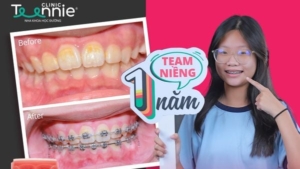 Giải đáp thắc mắc: Trẻ 14 tuổi đã niềng răng được chưa?