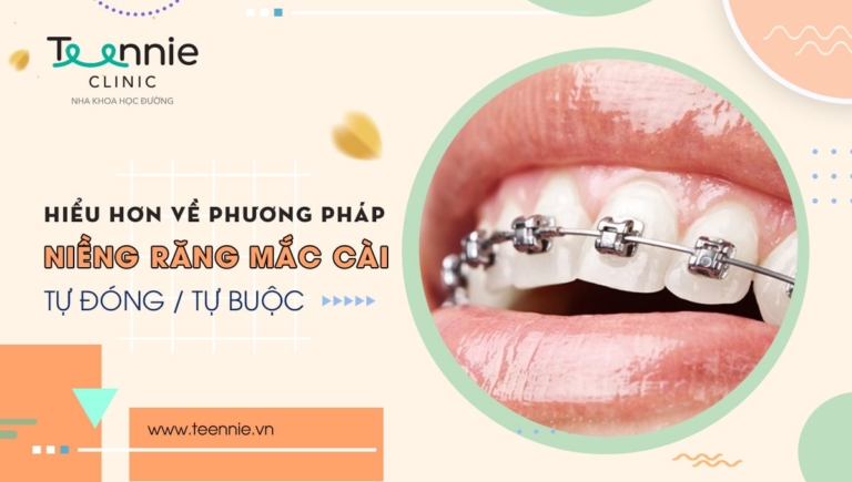 Hiểu hơn về phương pháp niềng răng mắc cài tự đóng/ tự buộc