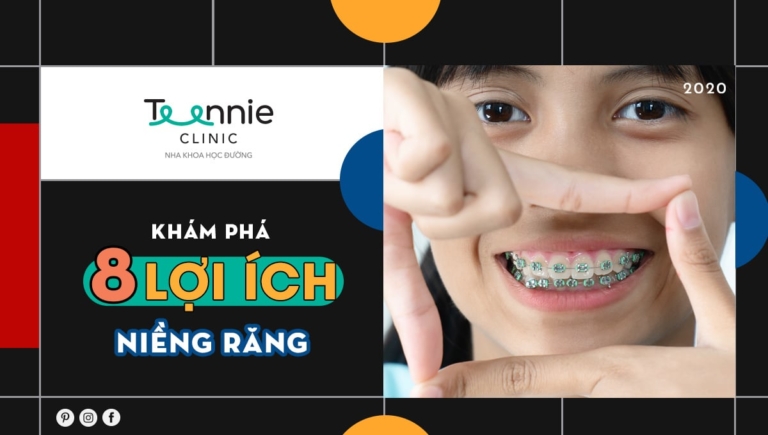 Khám phá 8 lợi ích niềng răng có thể khiến bạn “bất ngờ”