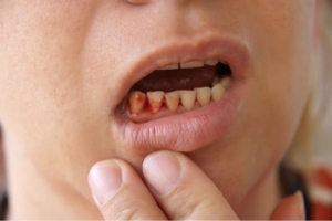 Nên ăn gì khi đang bị chảy máu chân răng?