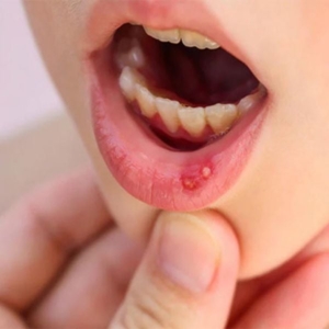 Nhiệt miệng là dấu hiệu của bệnh lý gì?