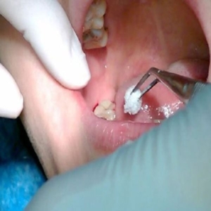 Nhổ răng khôn 2 tuần vẫn đau có gây nguy hiểm?